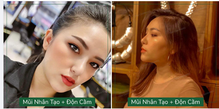 Da mũi dày nhìn phát là biết ngay, nhưng phương pháp nâng mũi nào để làm nên chiếc mũi đẹp thì nhìn 1 lần khó biết lắm