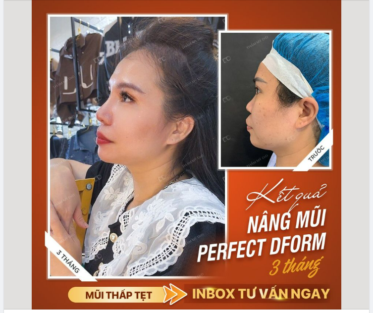 DA MŨI MỎNG ​​​​​​​ KHÔNG CÓ SỐNG MŨI