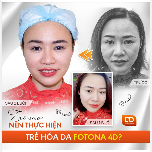 DA SĂN CHẮC, SÁNG MỊN, MỜ NẾP NHĂN NHỎ sau 3 buổi điều trị TRẺ HÓA FOTONA 4D ACITVE
