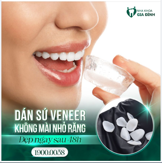 DÁN SỨ VENEER SIÊU MỎNG KHÔNG MÀI NHỎ RĂNG