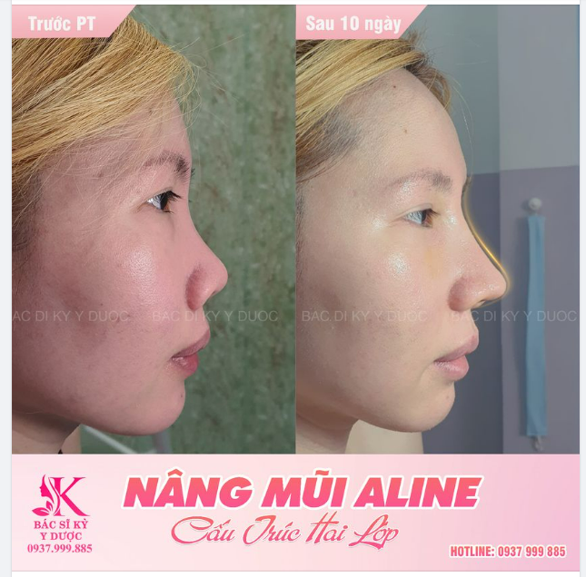 Dáng mũi ALINE độc quyền tại Bác Sĩ Kỳ y Dược