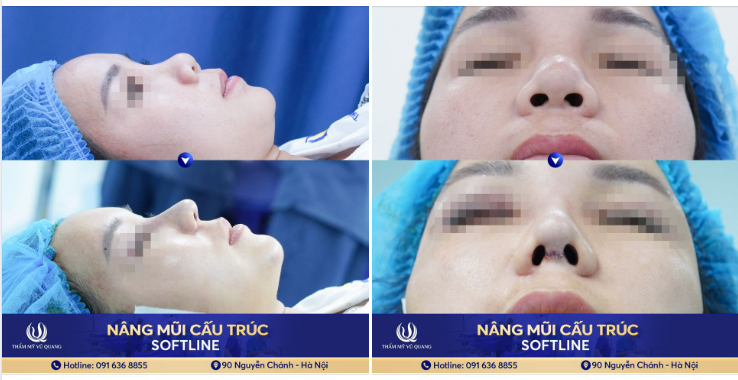 Dáng mũi cấu trúc Softline ngay sau làm.