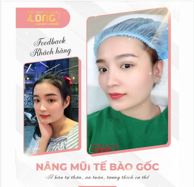 Dáng mũi đẹp xinh xuất sắc hiệu quả ổn định.