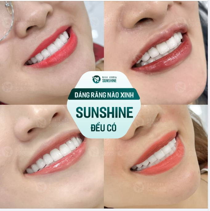 DÁNG RĂNG NÀO SINH SUNSHINE ĐỀU CÓ