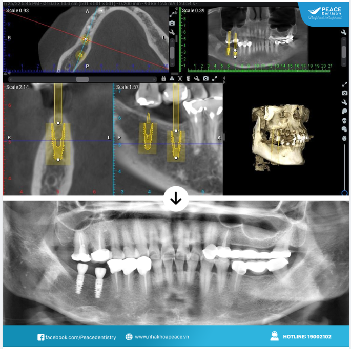 ĐẶT IMPLANT MÔ PHỎNG TRÊN PHẦN MỀM - SỰ ĐẢM BẢO CHO TÍNH CHÍNH XÁC VÀ TỐI ƯU TỪ VIỆC CHẨN ĐOÁN, LẬP KẾ HOẠCH ĐIỀU TRỊ CHO ĐẾN KẾT QUẢ THỰC TẾ