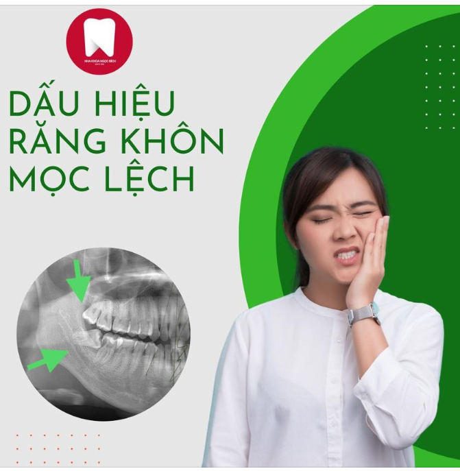 DẤU HIỆU NHẬN BIẾT RĂNG KHÔN MỌC LỆCH