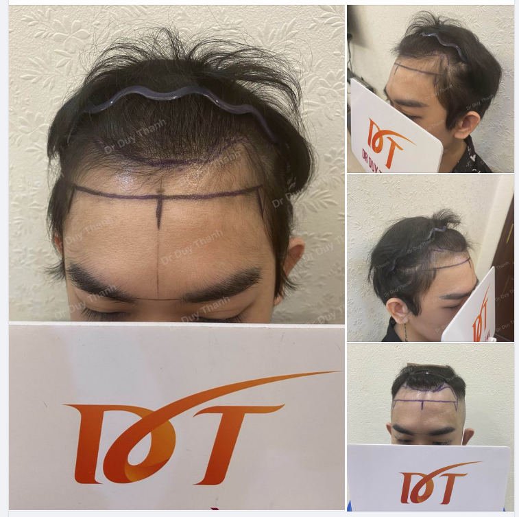 ĐẦU TUẦN KHỞI ĐỘNG CA CẤY TÓC 2000 NANG- BOY QUY NHƠN 27 TUỔI
