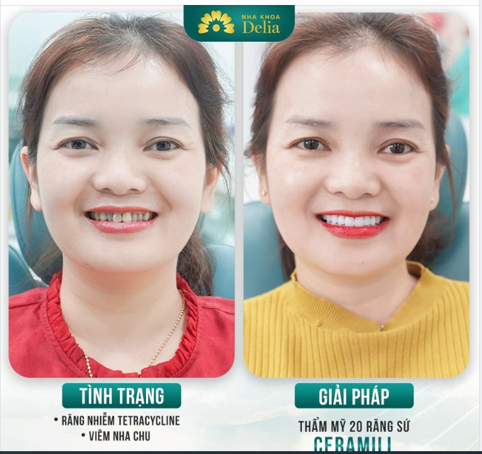 Delia giải cứu thành công răng nhiễm Tetracycline