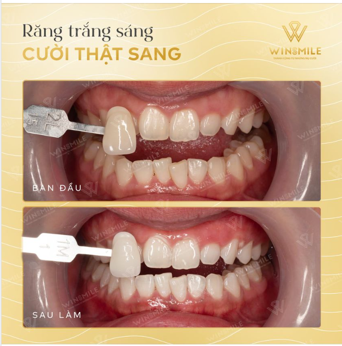 ĐẸP RẠNG NGỜI VỚI NỤ CƯỜI TRẮNG SÁNG