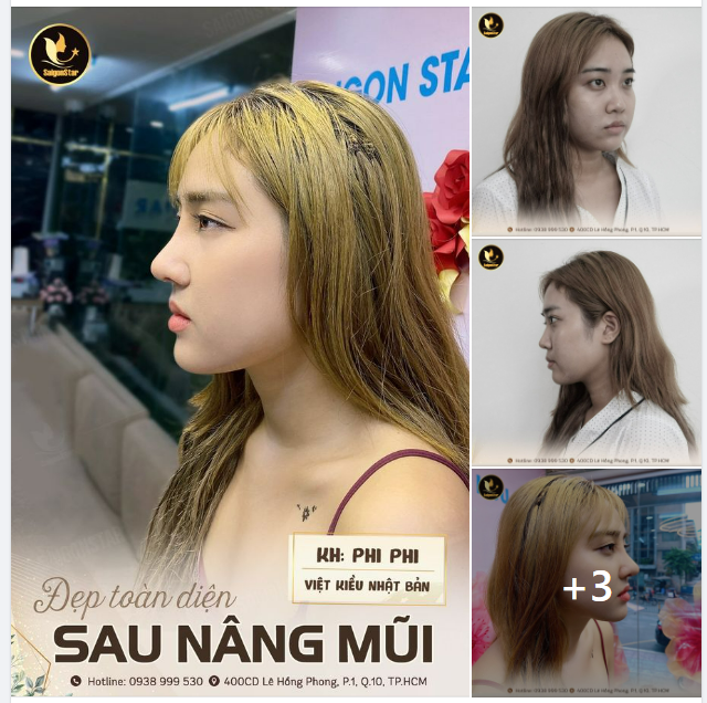 ĐẸP TOÀN DIỆN SAU NÂNG MŨI TẠI DR.HOẠT