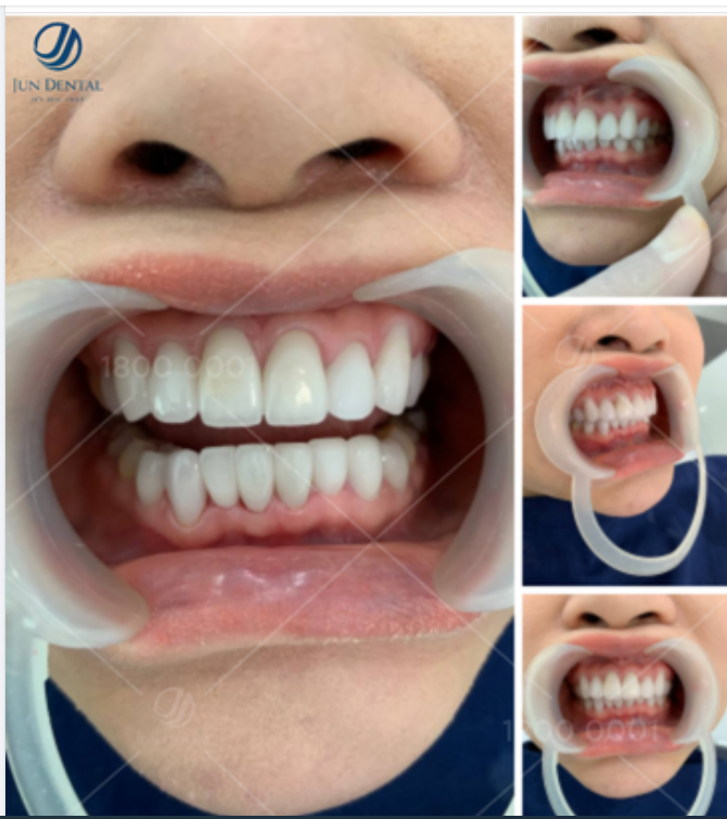 Điều đầu tiên giúp mình gây ấy tượng tốt đó chính nụ cười tươi sáng. Mình tự tin 100% với hàm răng mới trắng đều, đẹp tự nhiên