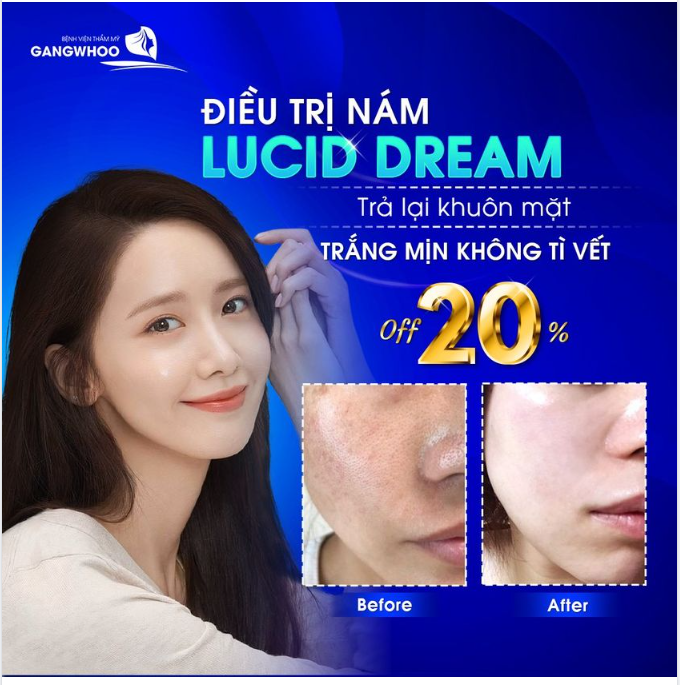 ĐIỀU TRỊ NÁM LUCID DREAM TRẢ LẠI KHUÔN MẶT TRẮNG MỊN KHÔNG TÌ VẾT