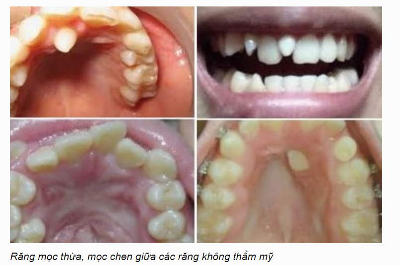 Điều trị răng mọc thừa chèn vào 2 răng cửa như thế nào?