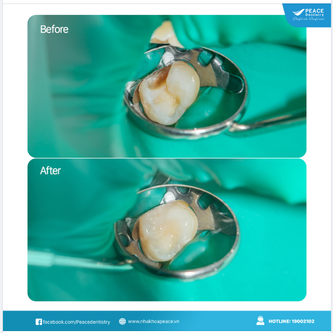 ĐIỀU TRỊ SÂU RĂNG HIỆU QUẢ VỚI PHƯƠNG PHÁP TRÁM RĂNG THẨM MỸ QUANG TRÙNG HỢP - VẬT LIỆU COMPOSITE