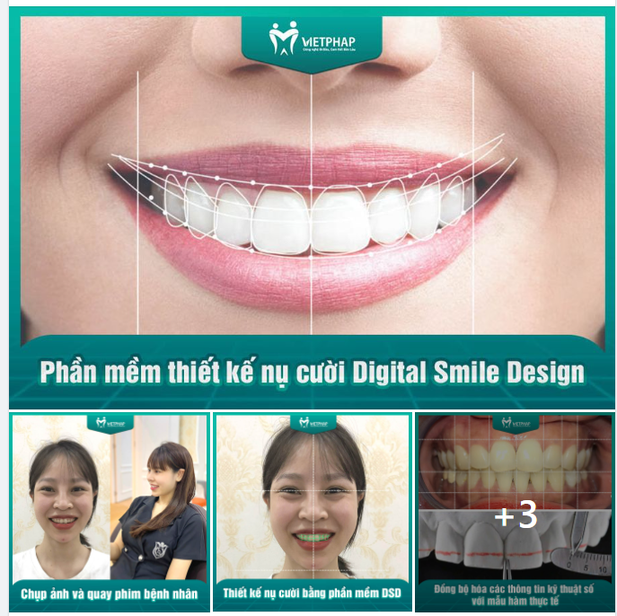 DIGITAL SMILE DESIGN – PHẦN MỀM THIẾT KẾ NỤ CƯỜI SỐ 4.0