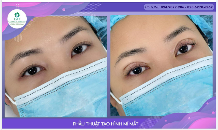 Đôi mắt không rõ mí , góc mắt nhỏ Hai mí rõ, tròn, đều và long lanh hơn CHỈ NGAY SAU 15 phút phẫu thuật.