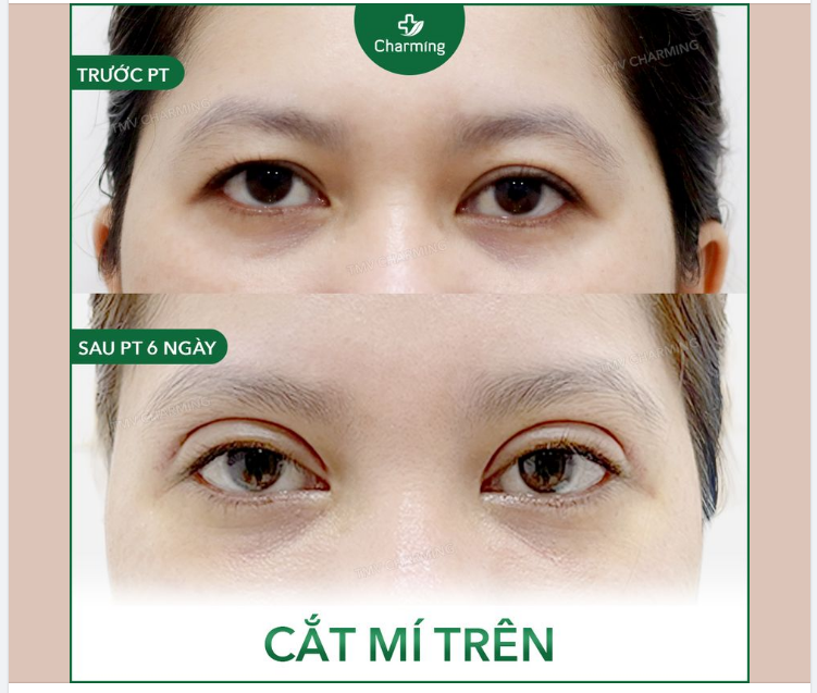 Đôi mí trước đây của bạn khách này xuất hiện da chùng nên làm mí sụp xuống. Nếu có thể ngược thời gian về 10 năm trước thì hẳn đây sẽ là một đôi mí đẹp.