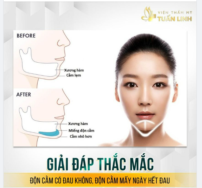 Độn cằm có đau không Độn cằm mấy ngày hết đau 