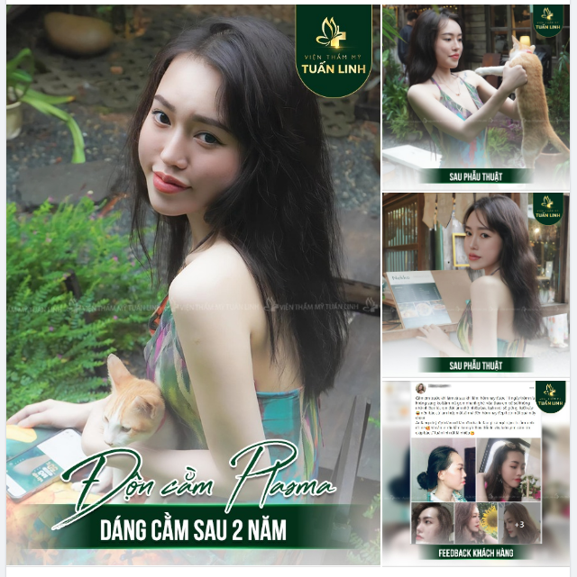 Độn cằm Plasma - dáng cằm sau 2 năm được thực hiện bởi Tuấn Linh