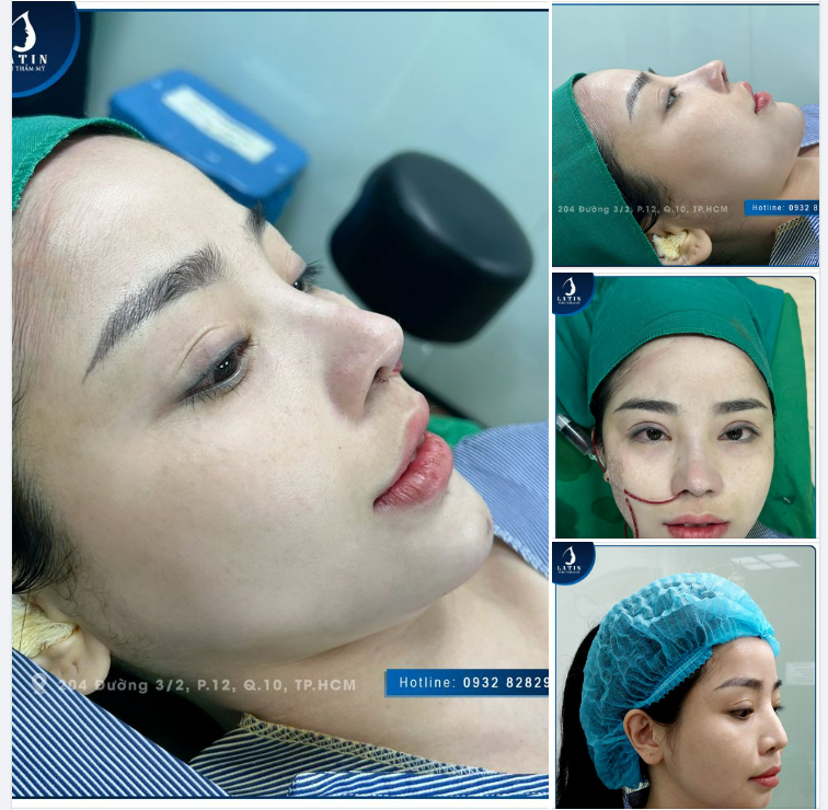 Độn cằm sụn Mỹ kết hợp nâng mũi cấu trúc sửa lại cho khách hàng