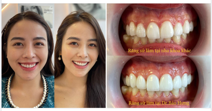 Đón chào nụ cười mới với những chiếc răng xinh xinh