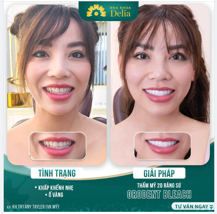 Đừng để hàm răng làm giới hạn nụ cười của bạn.!
