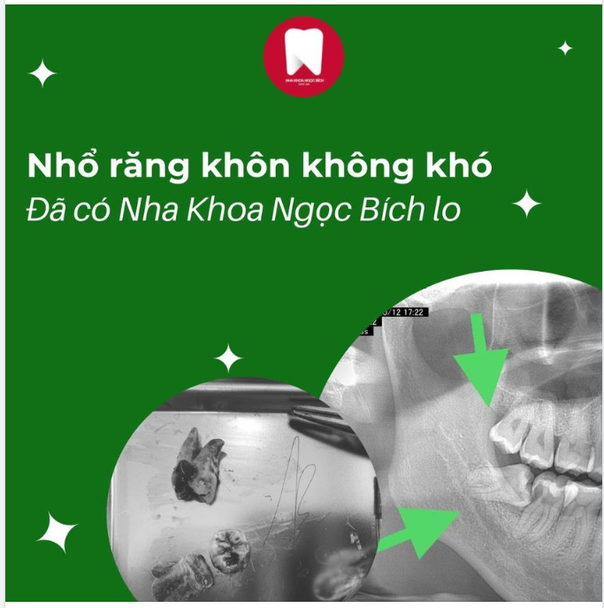 Đừng lo lắng khi chọn nhổ răng tại Nha Khoa Ngọc Bích bởi vì