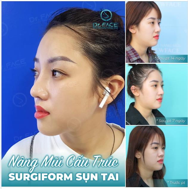Em đây rất thích đi làm Làm duyên làm dáng làm người anh thương…! Nghe kể từ hồi nâng mũi cấu trúc, cô bé này được bạn trai yêu thương hơn hẳn.