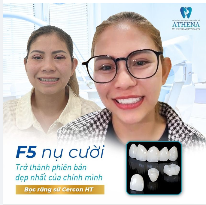 F5 NỤ CƯỜI VỚI BỌC RĂNG SỨ THẨM MỸ CERCON HT