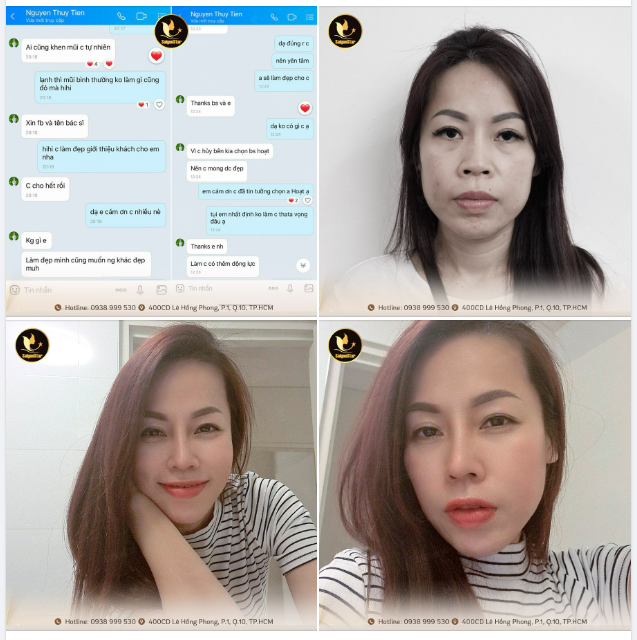 FEEDBACK 2 THÁNG NÂNG MŨI SỬA LẠI