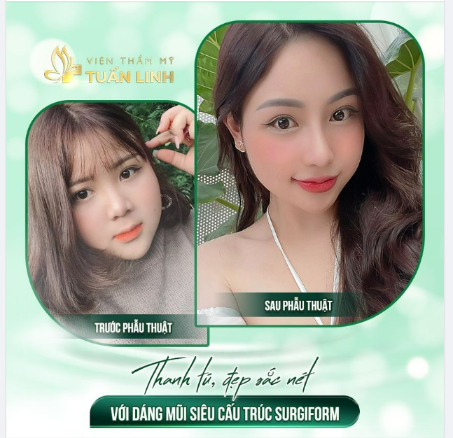  - Feedback chia sẻ siêu đáng yêu của khách hàng nhà Tuấn Linh sau nâng mũi siêu cấu trúc sụn Surgiform.