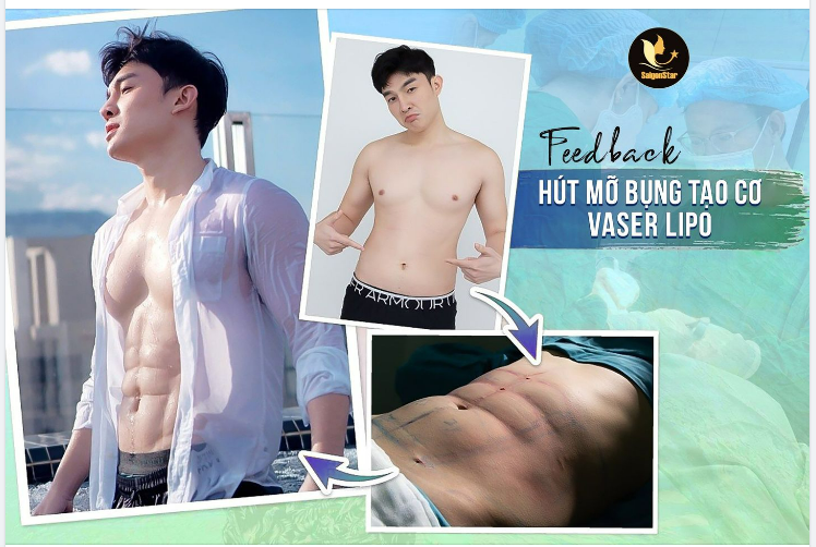 FEEDBACK HÚT MỠ BỤNG TẠO CƠ VASER LIPO