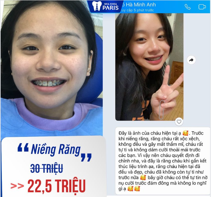 FEEDBACK KHÁCH HÀNG NIỀNG RĂNG