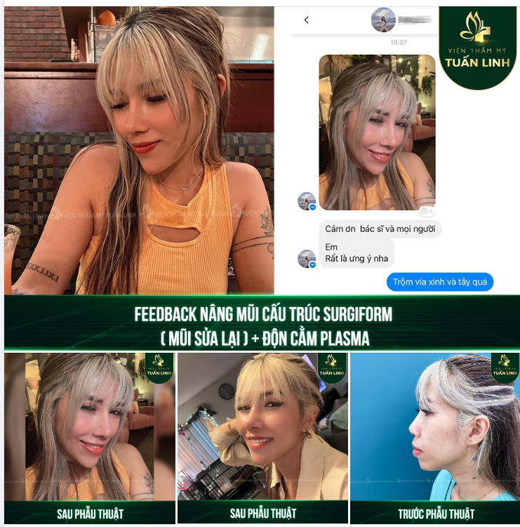 FEEDBACK NÂNG MŨI CẤU TRÚC SURGIFORM