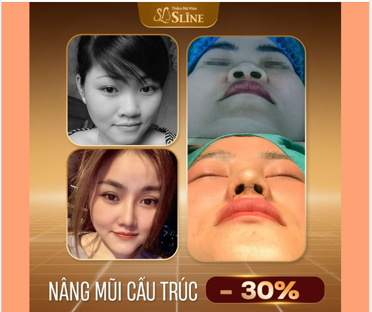 FEEDBACK NÂNG MŨI CẤU TRÚC.