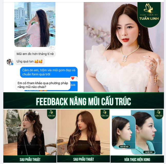 FEEDBACK NÂNG MŨI VÔ CÙNG CHẤT LƯỢNG CỦA KHÁCH NHÀ TUẤN LINH.