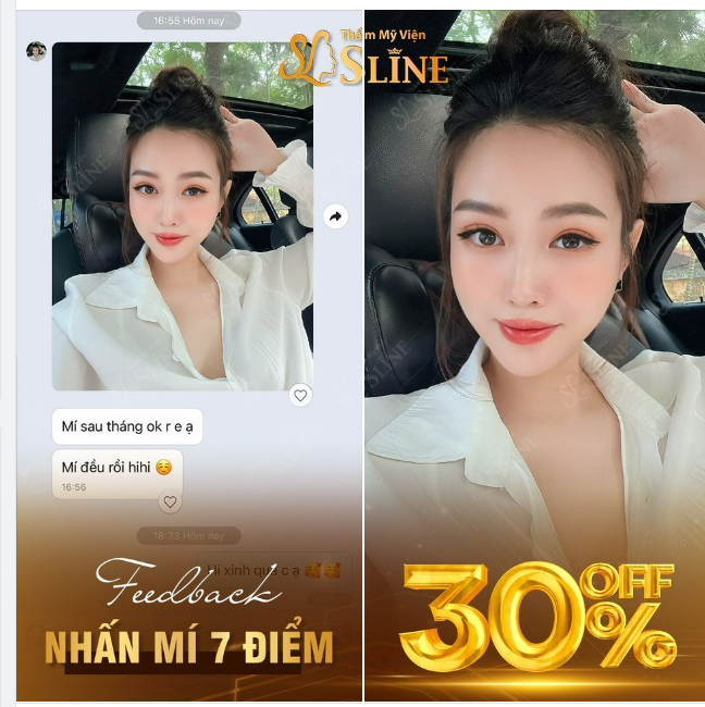 Feedback nhấn mí 7 điểm sau 1 tháng