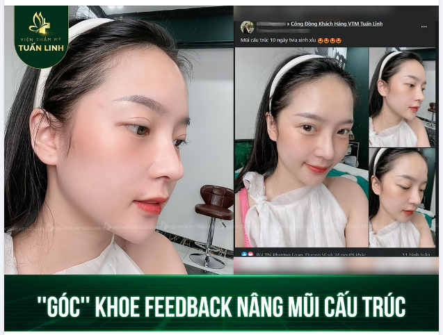 Feedback nâng mũi cấu trúc ngắn nhưng chất lượng