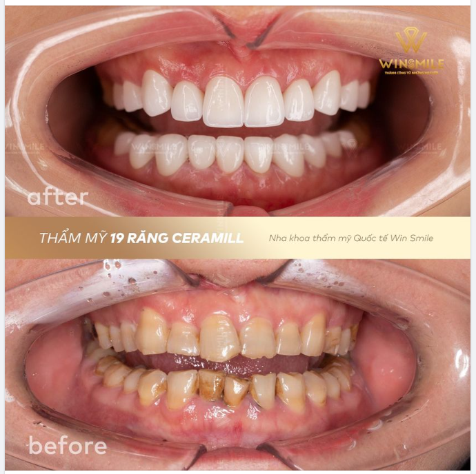 GẠT BỎ KHUYẾT ĐIỂM RĂNG MIỆNG, TỰ TIN TỎA SÁNG VỚI NỤ CƯỜI CERAMILL