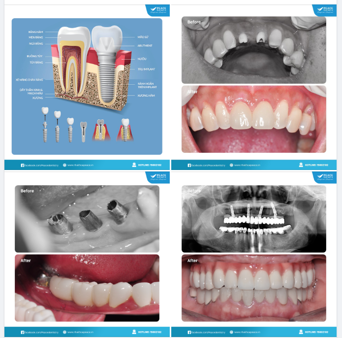 GIÁ TRỊ MÀ "RĂNG IMPLANT" MANG LẠI LÀ HOÀN TOÀN VƯỢT TRỘI SO VỚI MỌI PHƯƠNG PHÁP KHÁC