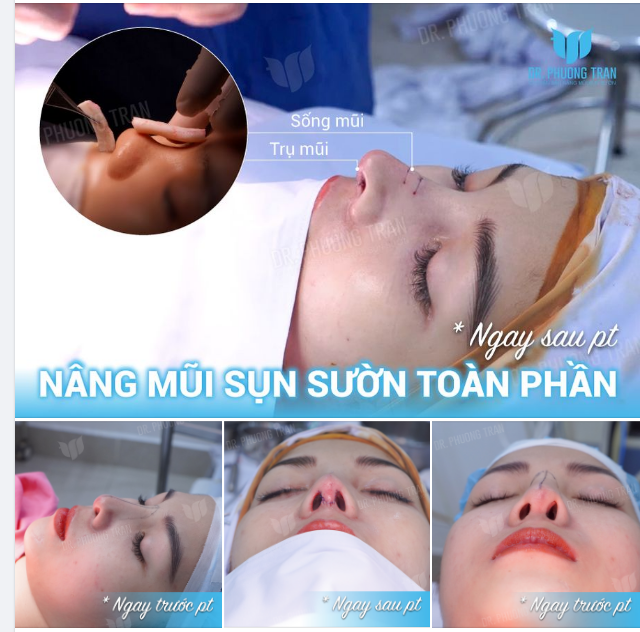 GIÁ TRỊ VỮNG CHẮC CỦA TRỤ MŨI SỤN SƯỜN LÀ ĐÂY!