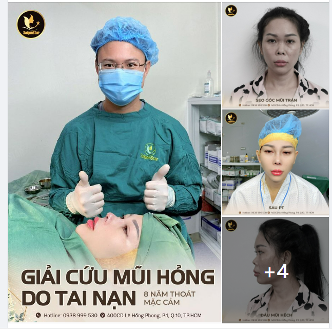 GIẢI CỨU MŨI HỎNG DO TAI NẠN