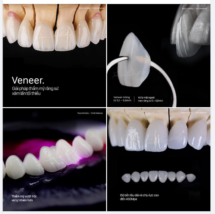 GIẢI ĐÁP 6 CÂU HỎI PHỔ BIẾN VỀ  MẶT DÁN SỨ VENEER