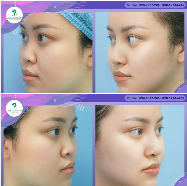 Giải pháp cho đầu mũi ngắn, hếch và cánh mũi rộng