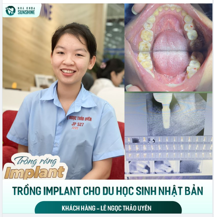 Giờ đây, Thảo Uyên đã tự tin thoải mái ăn nhai sau bao ngày chịu cảnh mất răng.