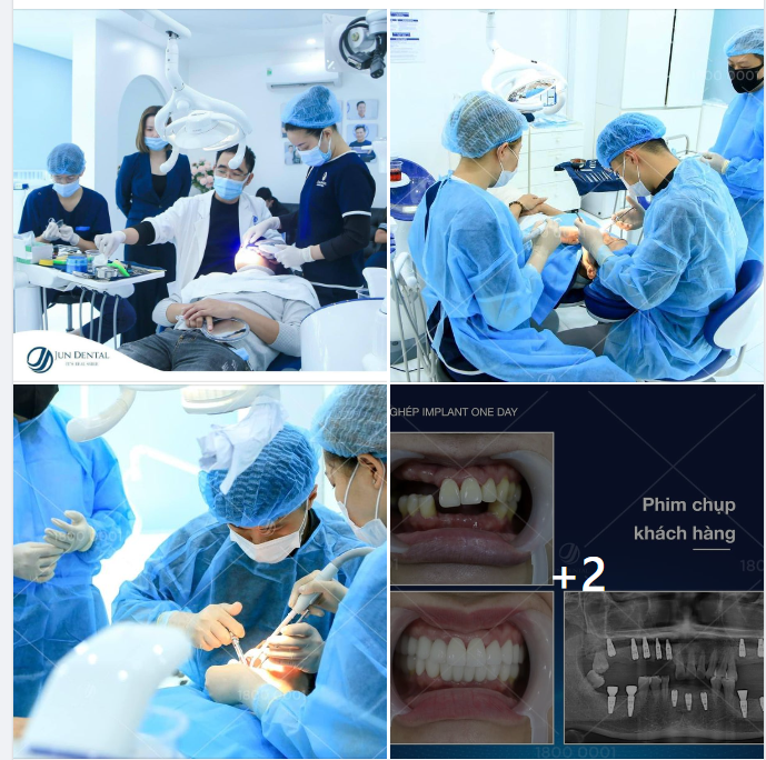 Giờ làm việc là 6h30 nghỉ, nhưng qua khách đến bảo trồng ngay cho a 3 Implant nên đội ngũ Y Bác sĩ bên mình đưa anh khách hàng lên chụp chiếu thực hiện.