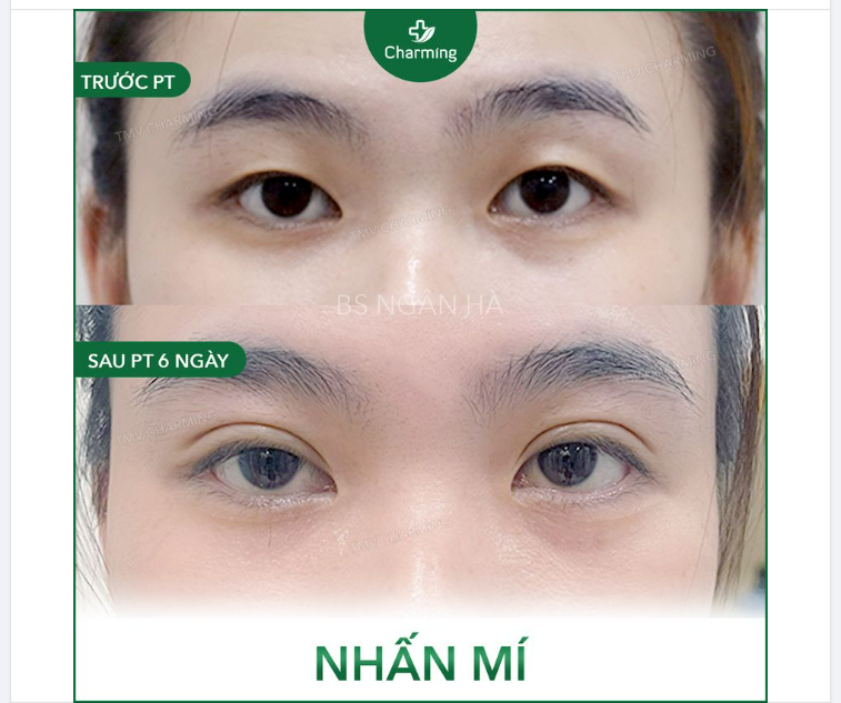Giờ mà đưa Charming ảnh ở dưới và nói đây là mí tự nhiên của bạn í chắc Charming cũng tin