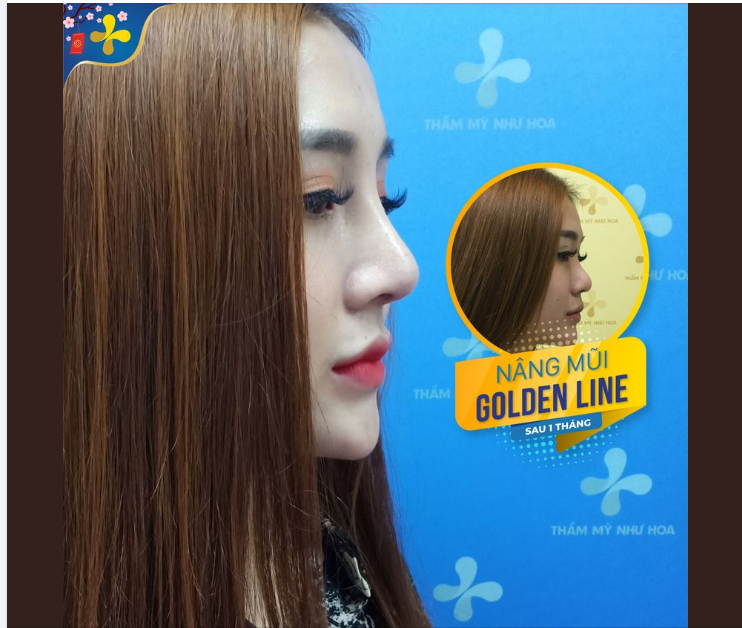 Góc nghiêng đẹp miễn chê sau khi nâng mũi Golden Line - Dr.Tống Hải.