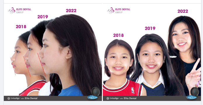 GÓC NHÌN NGHIÊNG HÀI HÒA SAU NIỀNG RĂNG INVISALIGN