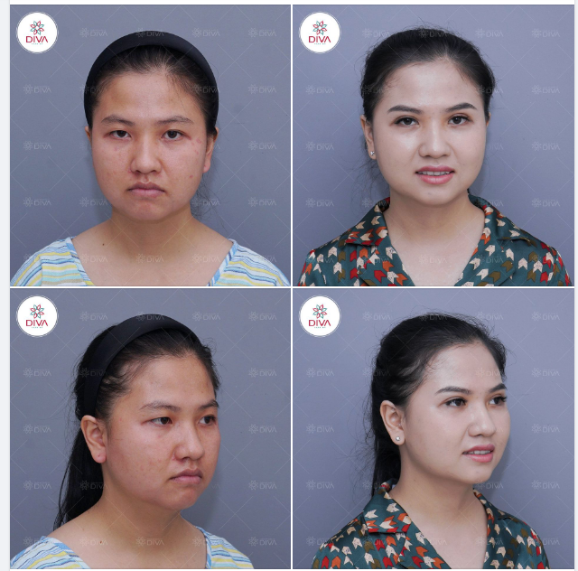 HAI MÍ ĐỀU, ĐÔI MẮT TO THU HÚT SAU CẮT MÍ MẮT